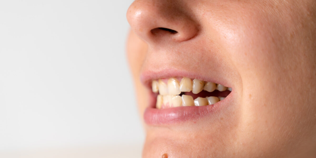 découvrez les meilleures solutions pour avoir des dents blanches à marseille. profitez de conseils d'experts, de traitements professionnels et de produits efficaces pour obtenir un sourire éclatant en toute sécurité.