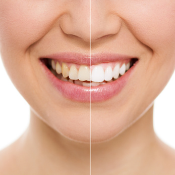 Pourquoi mes dents ne sont-elles pas toujours blanches ? Explications et solutions