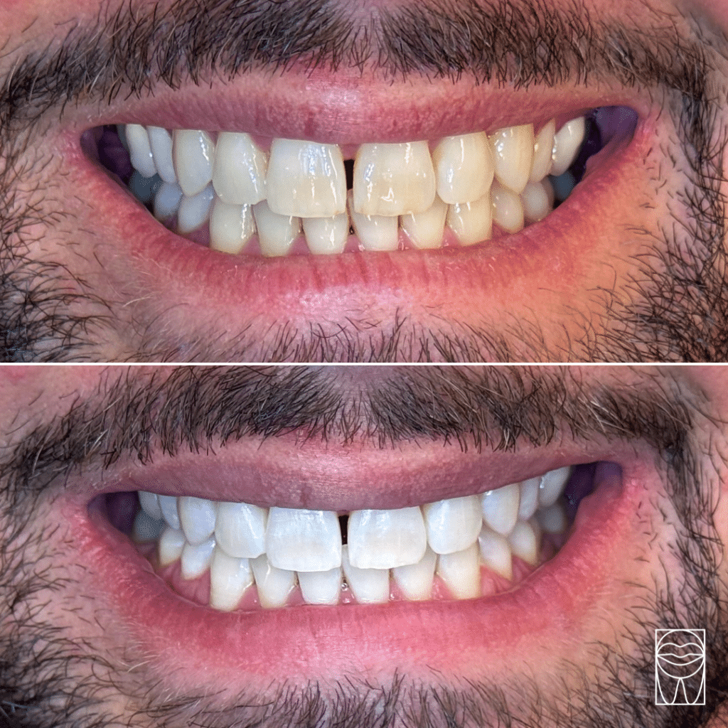 découvrez notre traitement innovant de blanchiment pour dents dévitalisées, conçu pour raviver l'éclat de votre sourire en toute sécurité. notre approche personnalisée vous garantit des résultats visibles et durables, tout en préservant la santé de vos dents. offrez-vous la confiance d'un sourire lumineux et radieux.