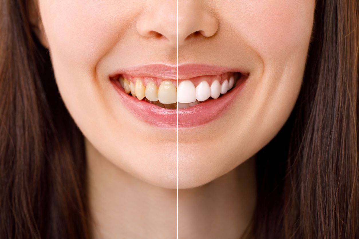 découvrez comment choisir la meilleure mutuelle pour le blanchiment des dents. comparez les offres et bénéficiez d'un sourire éclatant tout en maîtrisant votre budget santé.