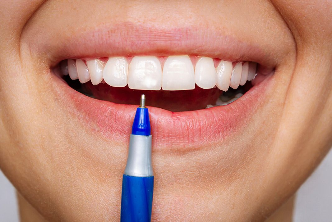 Dents qui se cassaient par carence : ma découverte choc