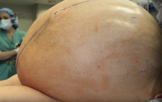 Kyste ovarien : symptômes et récit d’opération