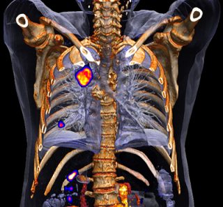 découvrez un témoignage détaillé sur le pet-scan, ses résultats et son utilité dans le diagnostic médical.