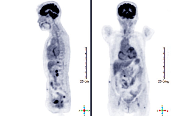 PET-scan : témoignage et résultat immédiat
