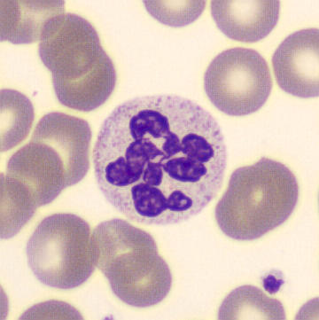 Polynucléaires neutrophiles élevés : causes et symptômes